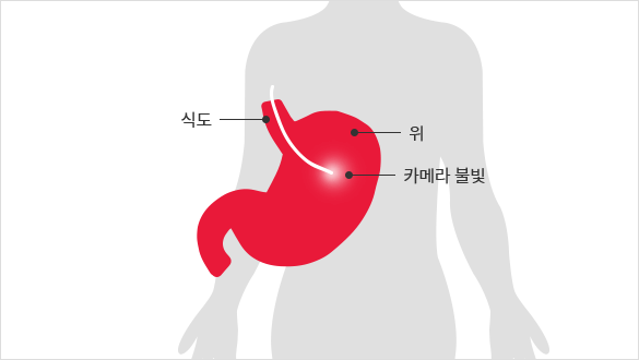 위내시경